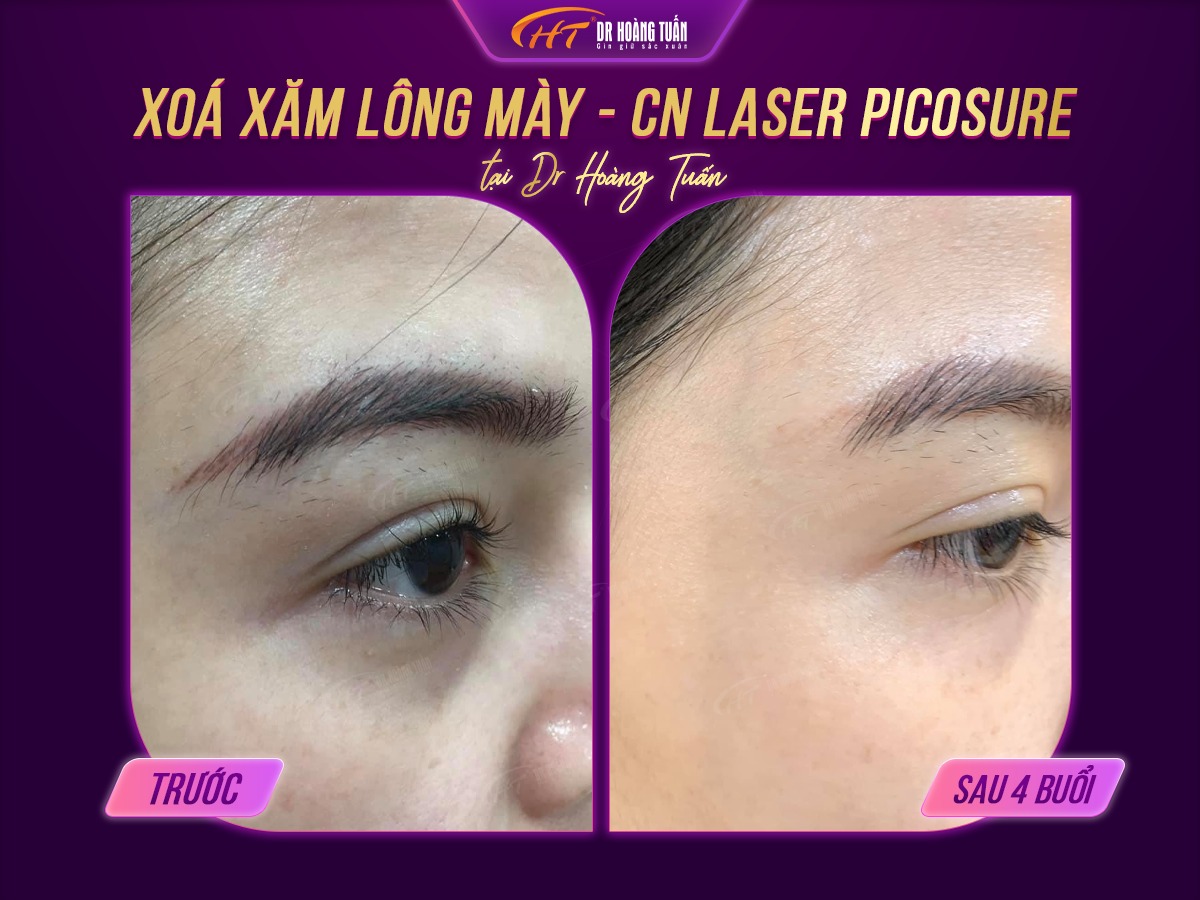 hình ảnh sau khi xóa xăm